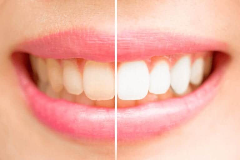 tandblegning før og efter