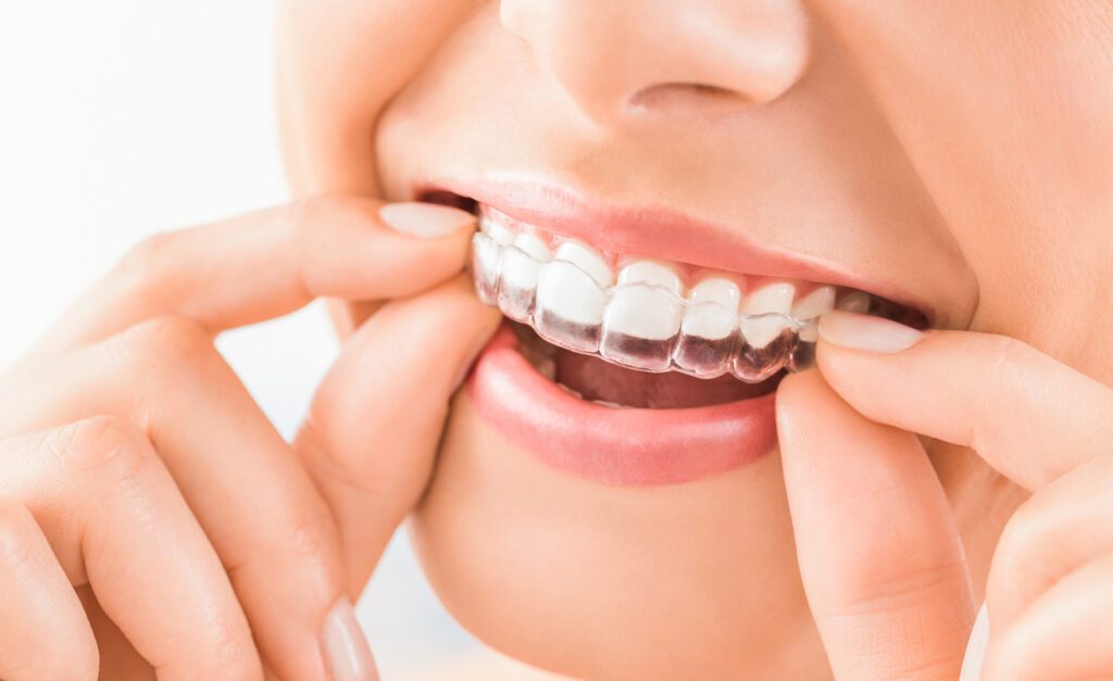 invisalign er usynlige eller gennemsigtige tandbøjler som sørger for tandretning.