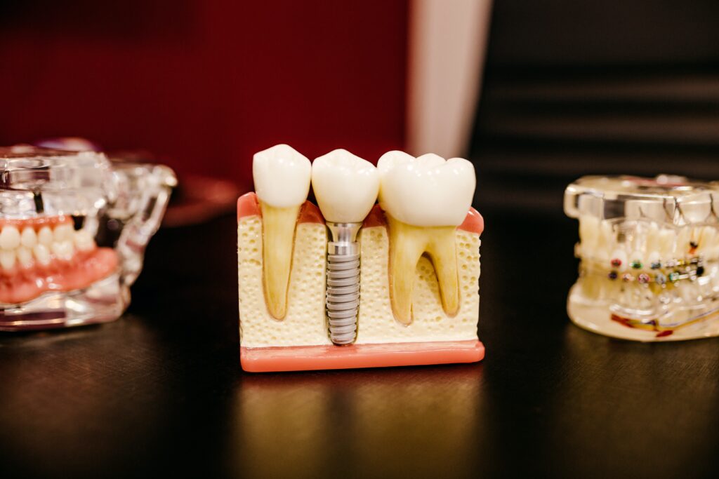 model af tandimplantater og proteser på et bord