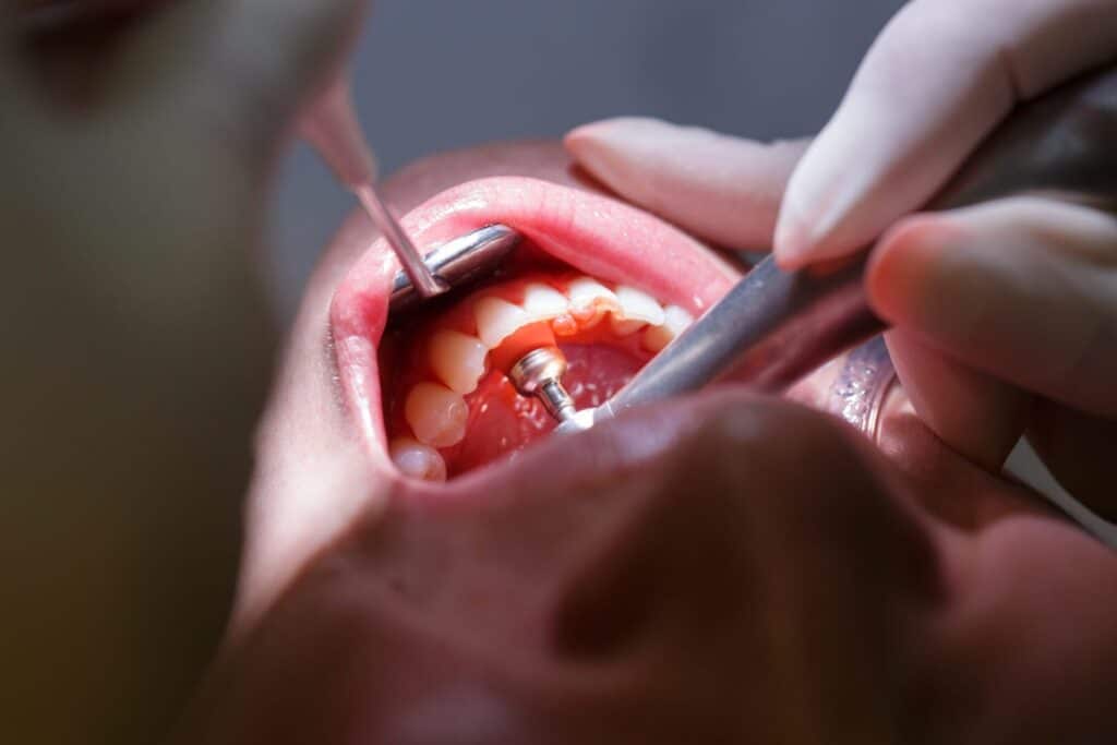 nærbillede af person som bliver tjekket hos tandlægen